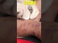What Is Behind The Symptoms Of Scabies What Is Behind The Symptoms Of Scabies