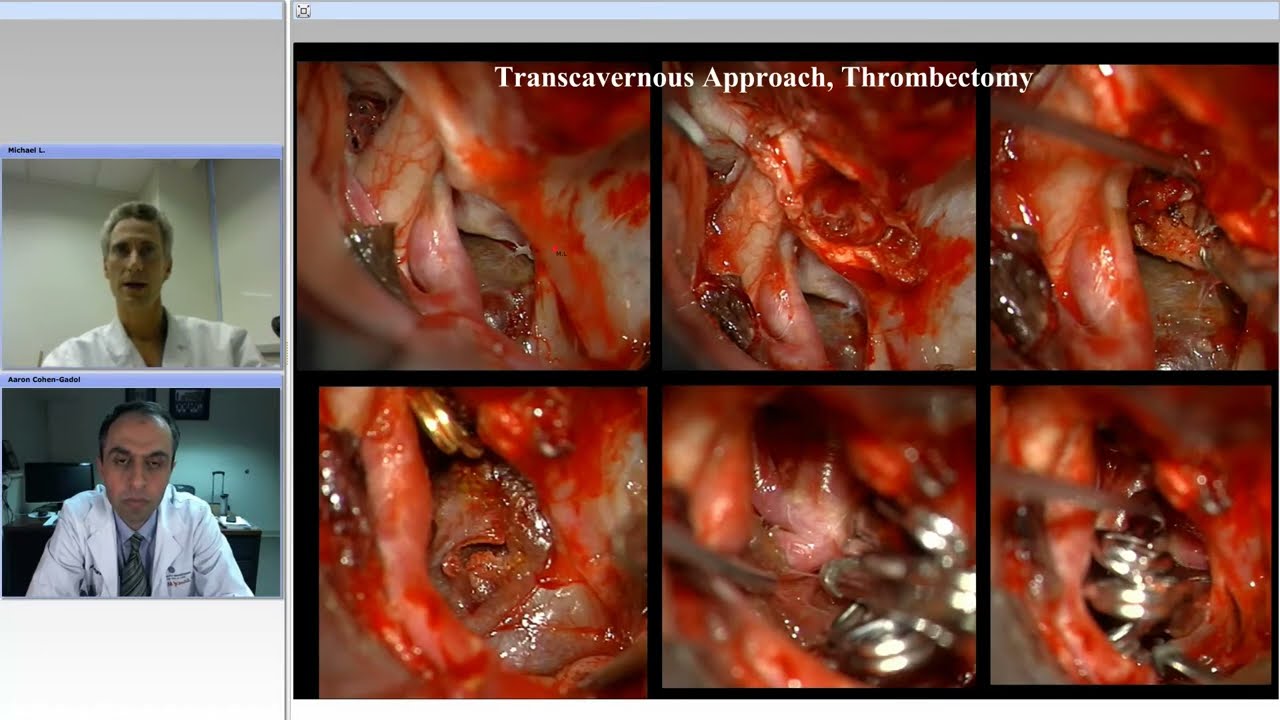 Giant Aneurysms: Techniques and Tenets for Ligation (Preview)