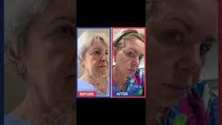Facelift Neck Lift Surgery Before And After In Turkey
