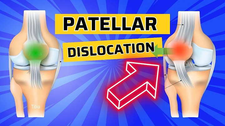 Top 3 Exercises after Patellar Dislocation- How to Strengthen the VMO