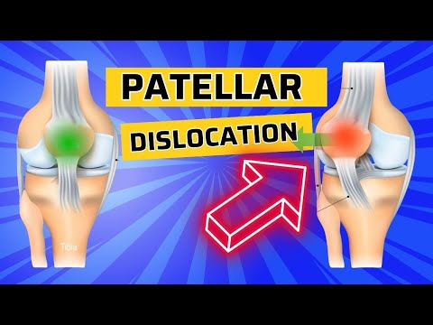 Top 3 Exercises after Patellar Dislocation- How to Strengthen the VMO
