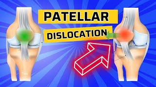 Top 3 Exercises after Patellar Dislocation How to Strengthen the VMO