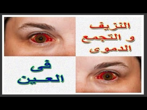 نزيف ملتحمة العين أسبابه وعلاجه البسيط السهل
