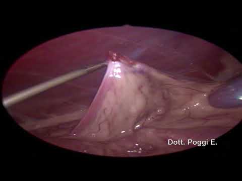 Video: Ovariectomia Laparoscopica Nei Cani In Gestazione Tardiva