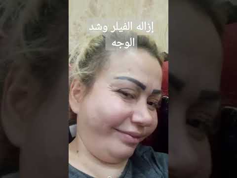 إزاله الفيلر وشد الوجه مع دكتور ياسر الشيخ والنتائج قبل وبعد مع ضيفتنا من لبنان 