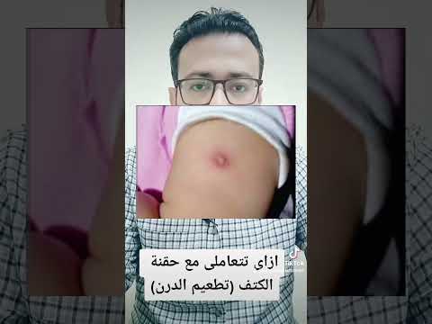 ازاى تتعاملى مع حقنة الكتف تطعيم الدرن