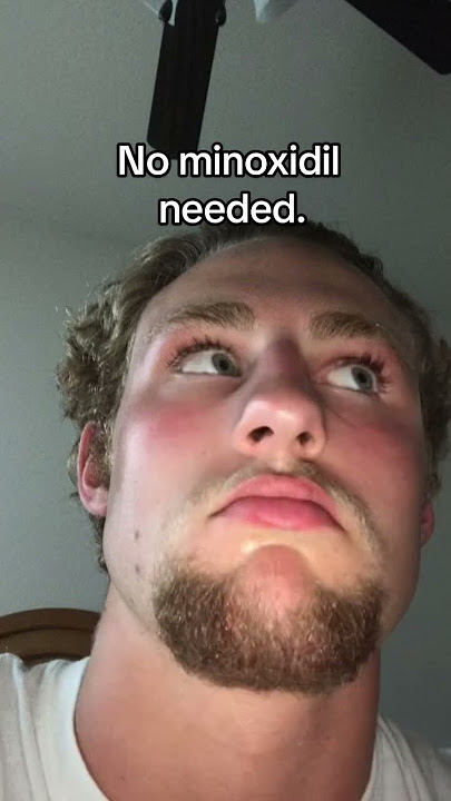 Did I use Minoxidil to grow my Beard?