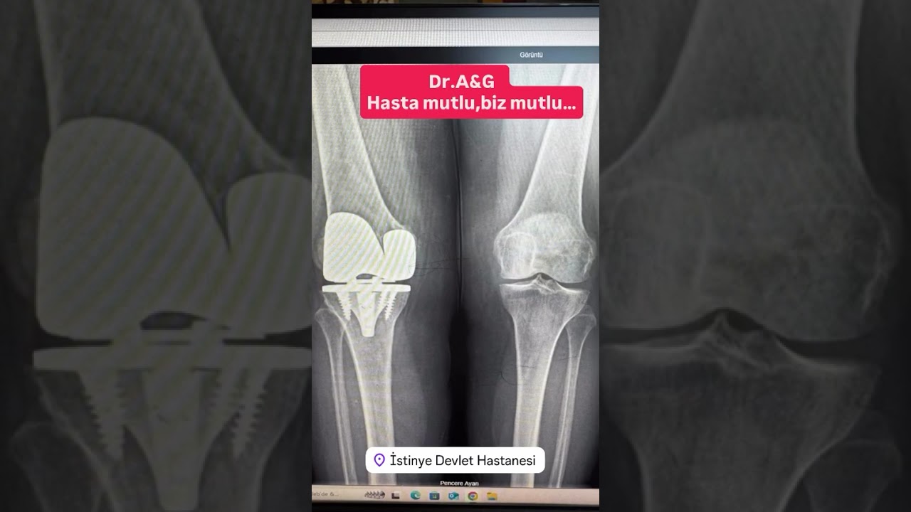 Sementsiz Diz Protezi Nedir?