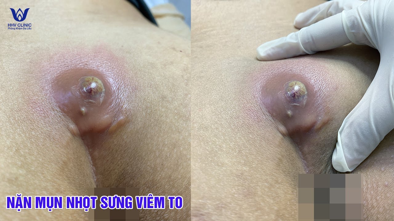 Nặn mụn áp xe ở vùng xương cụt sưng viêm - nhiều dịch mủ trắng.