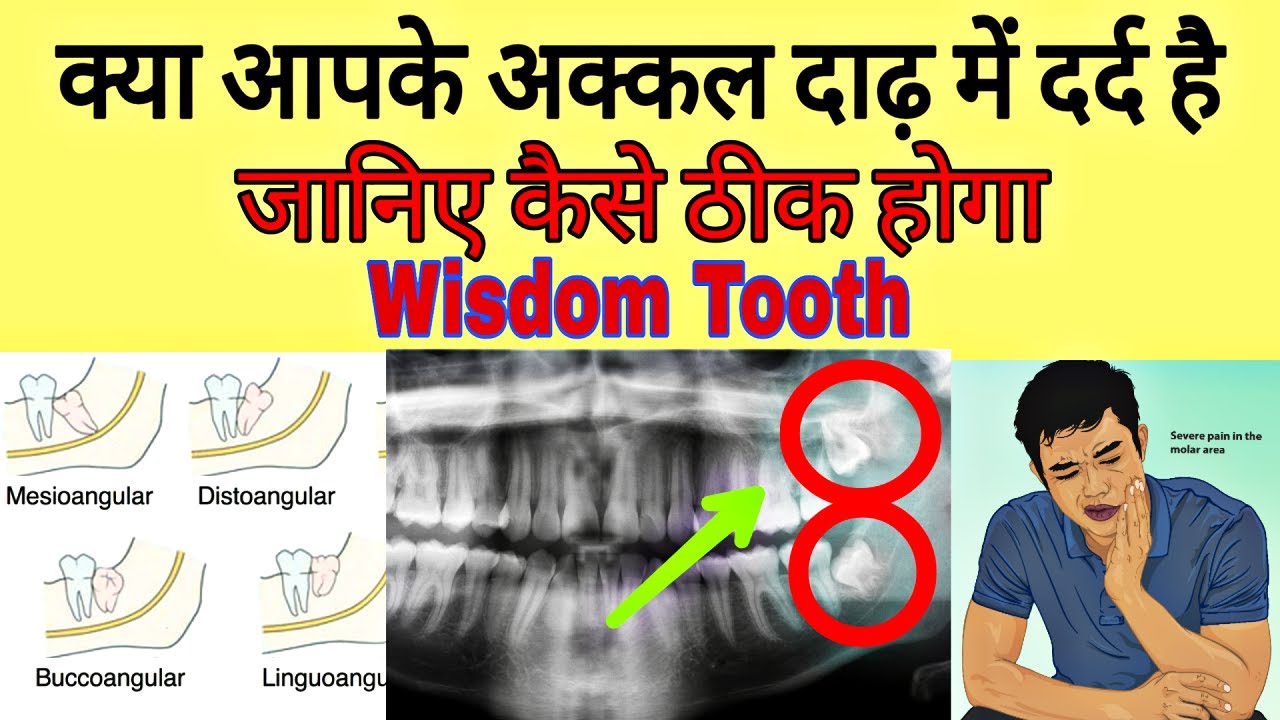 Akal Daad Ke Dard Ka Ilaj Wisdom Tooth Pain akal-daad-ke-dard-ka-ilaj-wisdom-tooth-pain