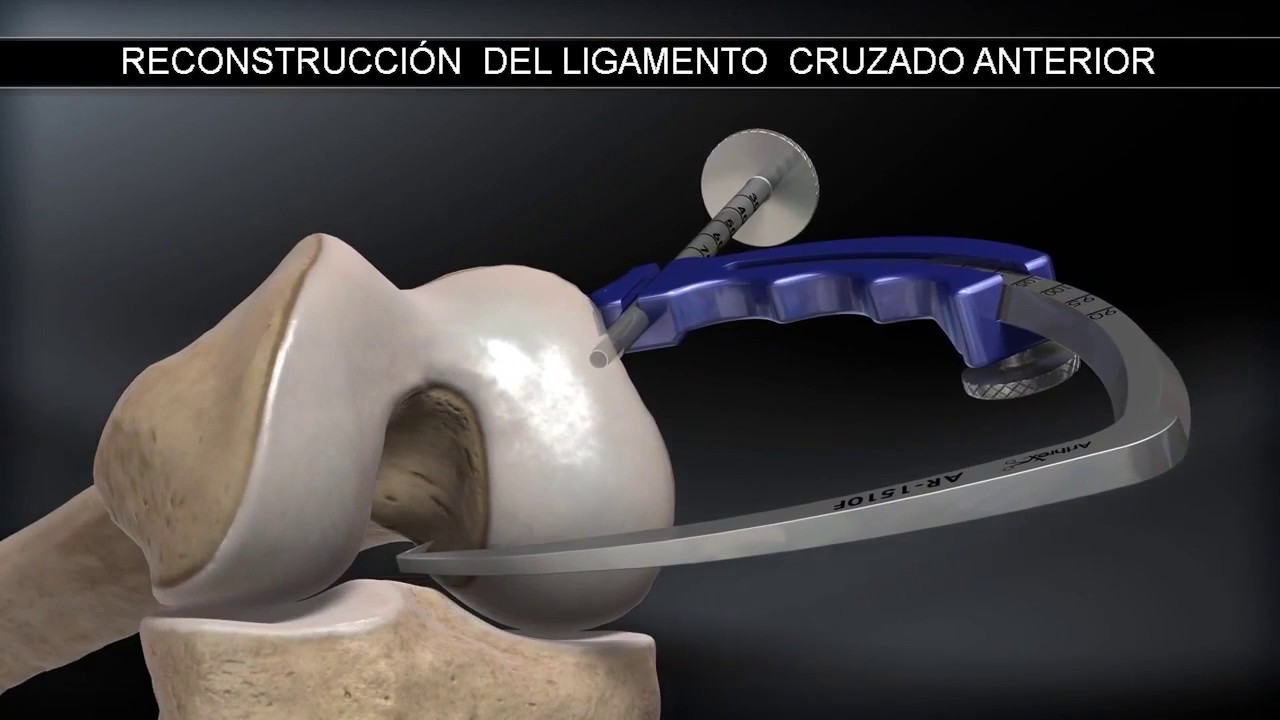 Se puede trabajar con el ligamento cruzado anterior roto