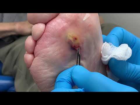 Video: Infected Blister: Hvordan Du Kan Vite Om Det Er Infisert, Behandling Og Bilder