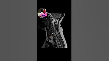MRI reporting - cervical spine