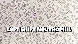 Left Shift Neutrophil or Bend Neutrophil in CBC Slide | In My Hematology Section | Rbc Morphology