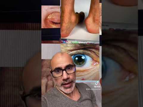 ٤٥ علامات ارتفاع الكولسترول الوراثي الدورة السويدية للصحة