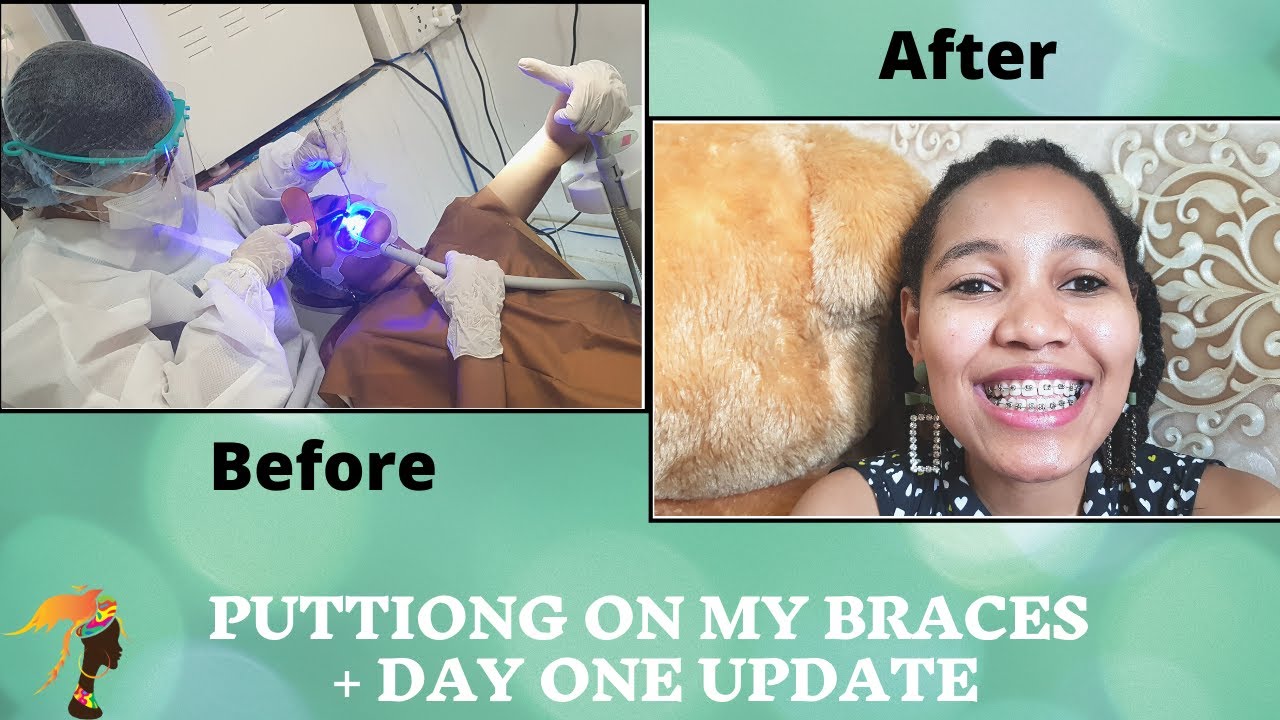 Putting Braces Pain level Post Braces Updates Metallic Braces