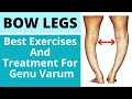 Bow Leg Correction Exercises And Treatment | How To Recover Bow Legs and Knee Pain |In Hindi