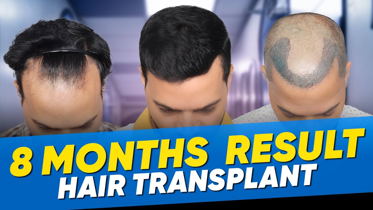 Hair Transplant in Chennai Best Results & Cost of Hair Transplant in