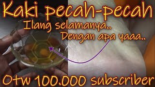 Tips mengatasi / mengobati kaki pecah - pecah | kaki mulus selamanya