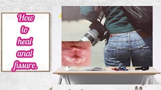 Anal fissure, 7 Home remedies to heal anal fissure. Anal fissure, 7 Home remedies to heal anal fissure.