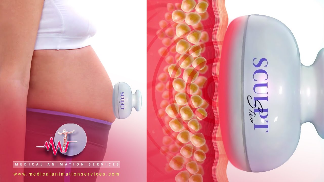 Fat Injection Animated Fat reducing Machine | 3D scientific animations | Skin animation | 3d ...