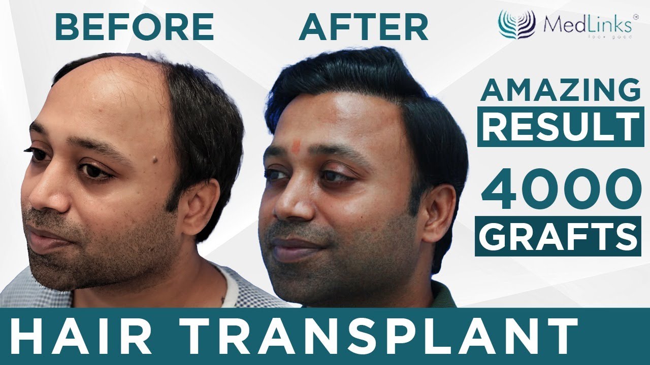 Best Hair Transplant Doctor in India  Dr Suneet Soni