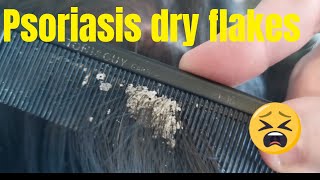 Scalp psoriasis removal - painful dry flakes