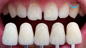 ¿Qué usan los actores para los dientes?