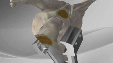 Latarjet for Instability