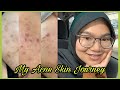 My Acne Skin Journey | Doktor Cakap Jerawat Batu & Insecure Teruk Guys😭