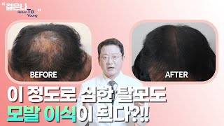 대량 모발 이식을 수술 한 번에 끝내는 '디에이징 모발 이식'!!