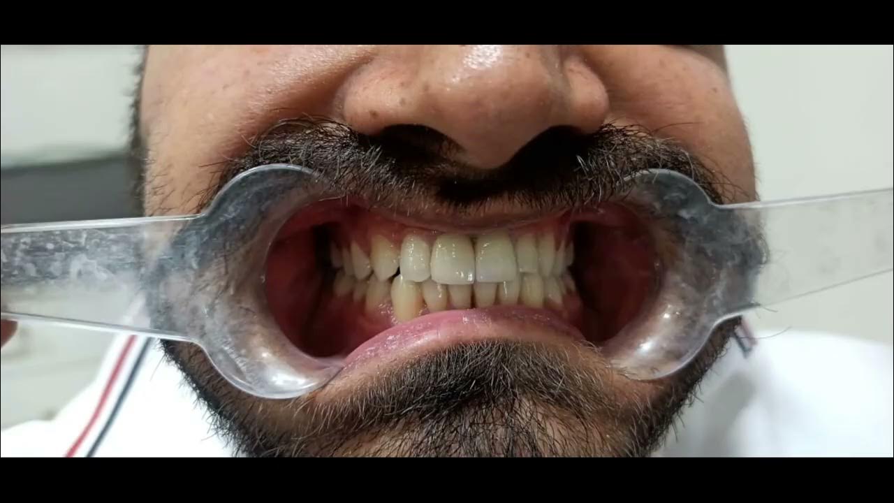 How to remove a zirconia crown changing zirconia crown YouTube