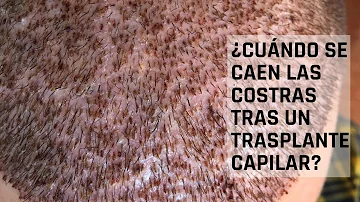 ¿Qué ocurre si no se caen las costras después del trasplante capilar?