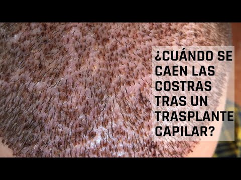 Video: ¿Se caen las costras?