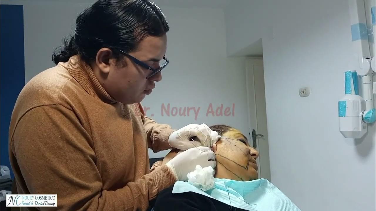 Neck lift using the Double Needle ( Thread lifting ) Dr. Noury Adel