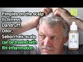 LEEMOONWON&#39;s RH Inflammation. what you have to do for Scalp treatment