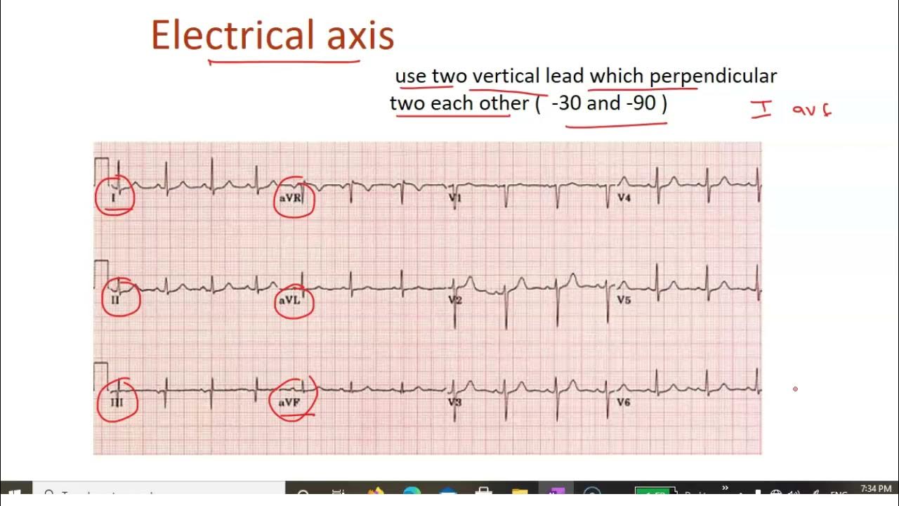 How to determine axis of ecg.. electrical axis cardiac axis
