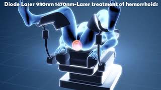 Laser Hemorrhoidoplasty (LHP) - IBI Healthcare Institute