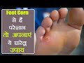 Foot Corn Home Remedies | Foot Corn को हमेशा के लिए ठीक कर देंगे ये घरेलू उपाय | Boldsky