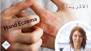 Hand Eczema / إكزيما اليد