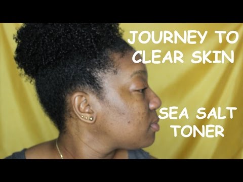 ►Journey to Clear Skin Ft. DIY Sea Salt Toner | ResilientCurlz