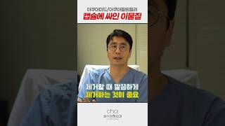 캡슐에 싸인 이물질 제거는? (아쿠아미드/아쿠아필링필러 등)