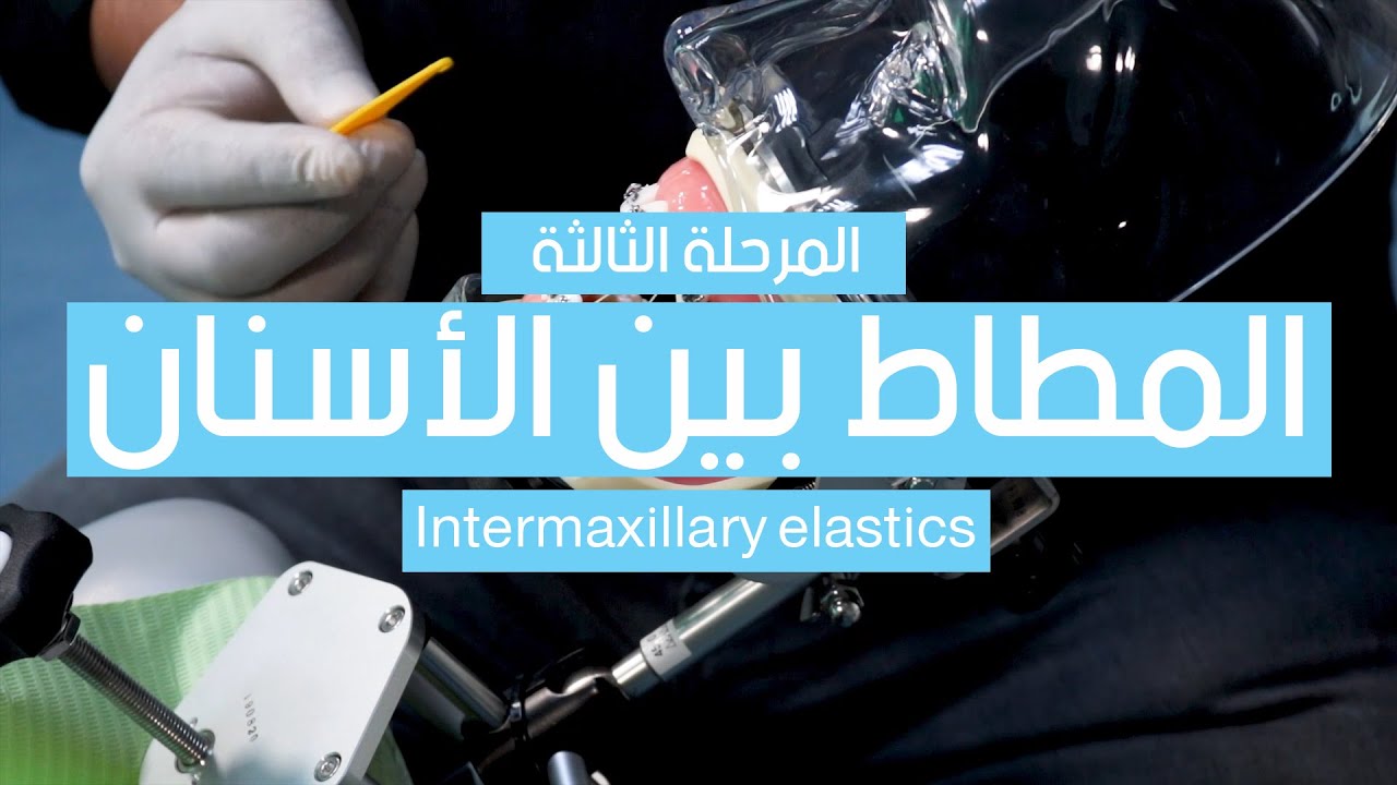 Inter maxillary elastics المرحلة الثالثة: تركيب المطاط بين الأسنان
