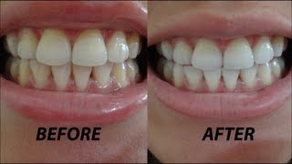 Crest 3D Whitestrips Vivid: Before & After, Demo + Review(, 2013-02-15T14:38:27.000Z)