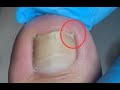 Satisfying! How to repair ingrown toenail!