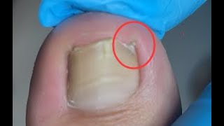 Satisfying How to repair ingrown toenail