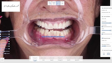 Medit Smile design App. My first experience.