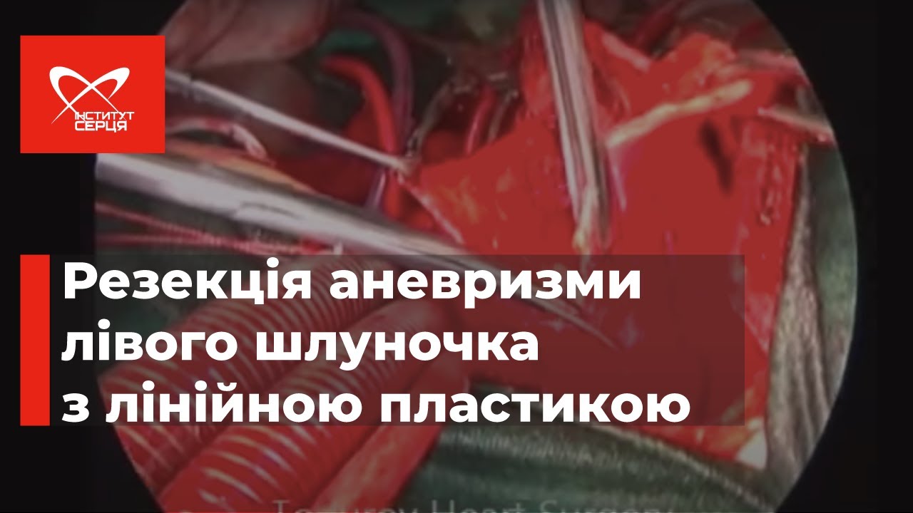 Резекція аневризми лівого шлуночка 🔷 Інститут серця