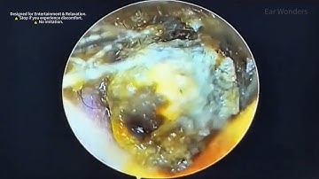 Giant & Slippery Earwax! The Most Satisfying Removal#Satisfying ASMR​#Ear Cleaning