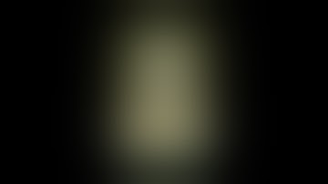 Complex Hilar Tumour  Partial Nephrectomy.